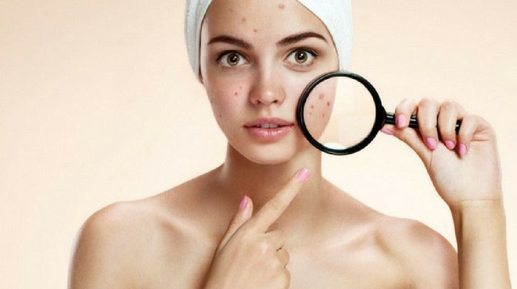 struggling with acne need moisturizing cream